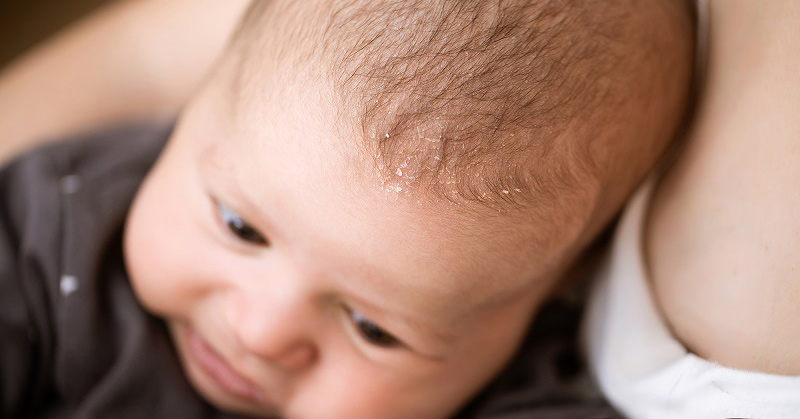 Trẻ sơ sinh có bị gàu không? Cách trị gàu hiệu quả cho trẻ sơ sinh